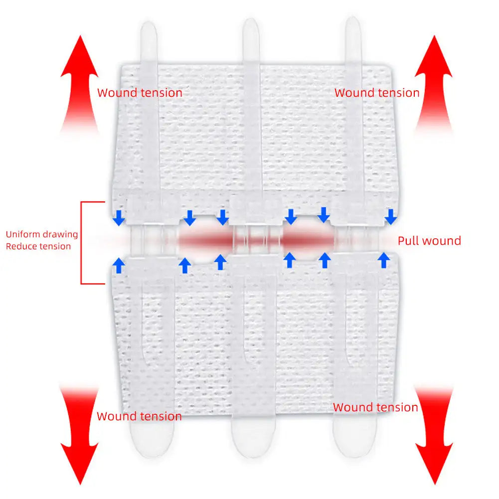Wound Dressing Closure Strips