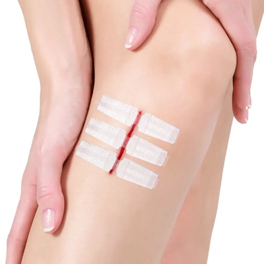 Wound Dressing Closure Strips